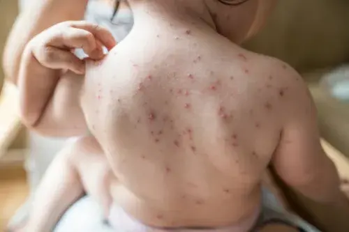 Chickenpox Vaccine